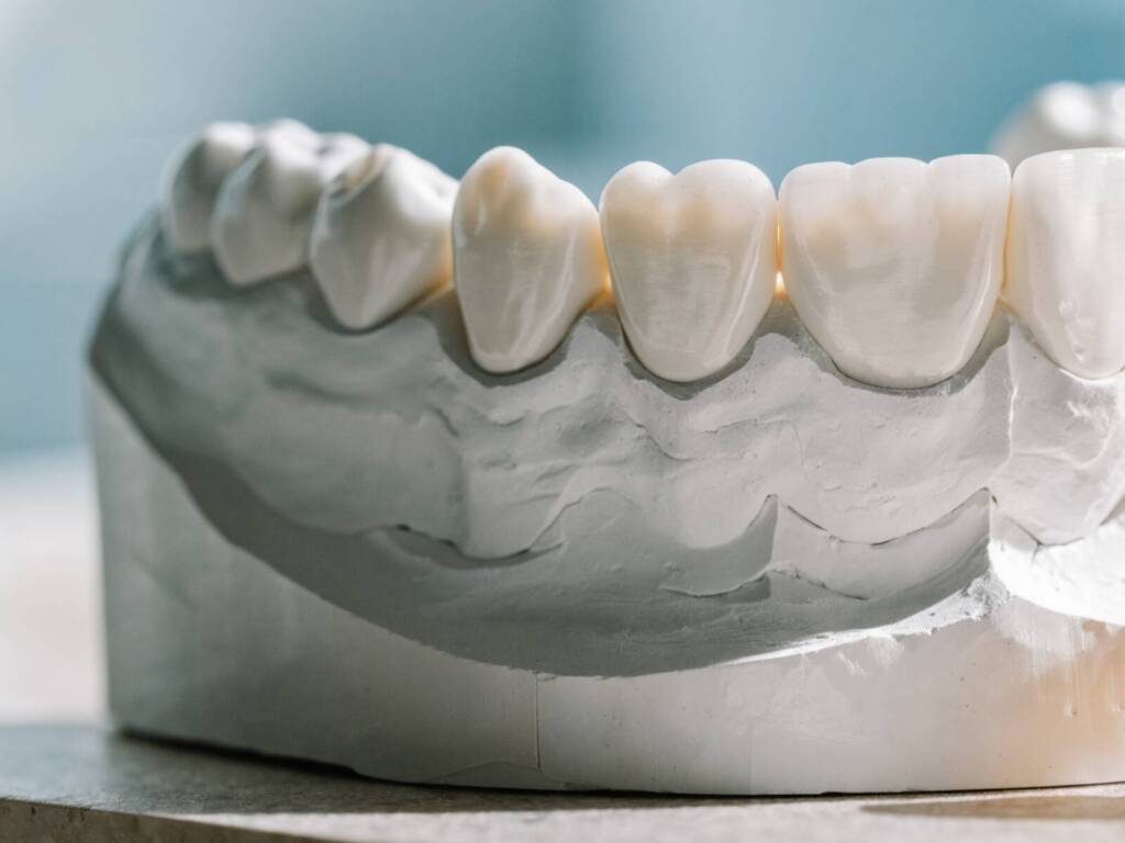 Modello in gesso con corone dentali in ceramica realizzate in laboratorio